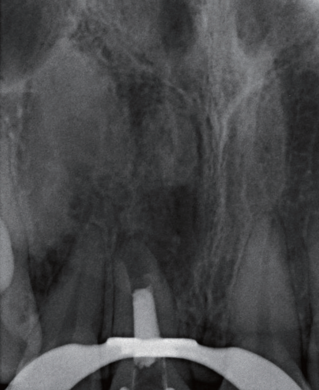 牙胶尖什么颜色MTA的临床应用——陈志平教授_https://www.jmylbn.com_新闻资讯_第11张