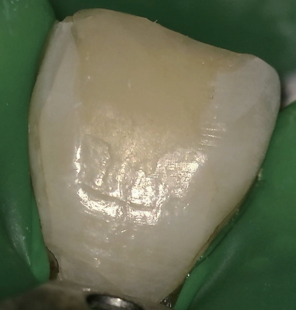 牙胶尖什么颜色MTA的临床应用——陈志平教授_https://www.jmylbn.com_新闻资讯_第4张