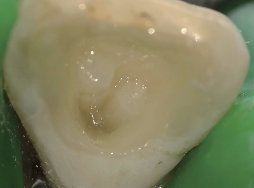 牙胶尖什么颜色MTA的临床应用——陈志平教授_https://www.jmylbn.com_新闻资讯_第13张