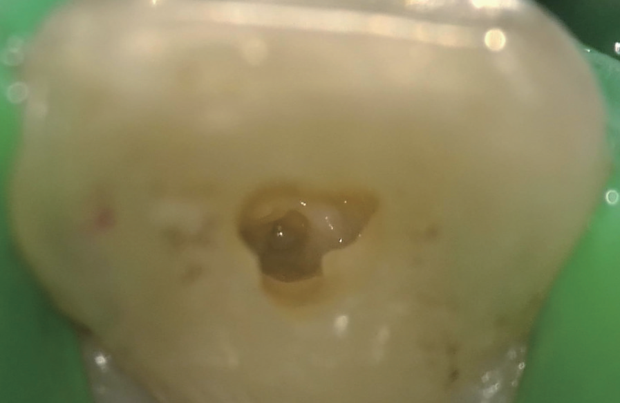 牙胶尖什么颜色MTA的临床应用——陈志平教授_https://www.jmylbn.com_新闻资讯_第7张