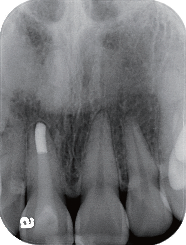 牙胶尖什么颜色MTA的临床应用——陈志平教授_https://www.jmylbn.com_新闻资讯_第19张