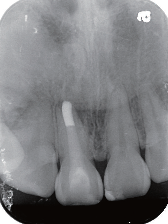 牙胶尖什么颜色MTA的临床应用——陈志平教授_https://www.jmylbn.com_新闻资讯_第16张