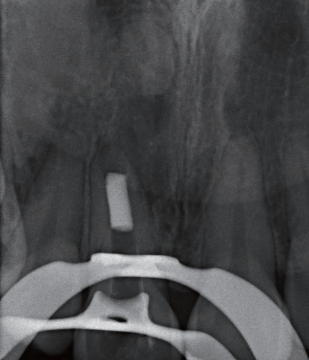 牙胶尖什么颜色MTA的临床应用——陈志平教授_https://www.jmylbn.com_新闻资讯_第12张