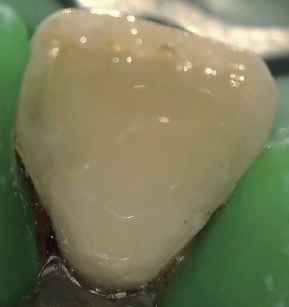 牙胶尖什么颜色MTA的临床应用——陈志平教授_https://www.jmylbn.com_新闻资讯_第14张