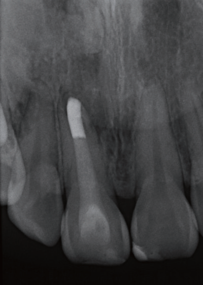 牙胶尖什么颜色MTA的临床应用——陈志平教授_https://www.jmylbn.com_新闻资讯_第15张