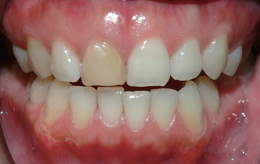 牙胶尖什么颜色MTA的临床应用——陈志平教授_https://www.jmylbn.com_新闻资讯_第17张