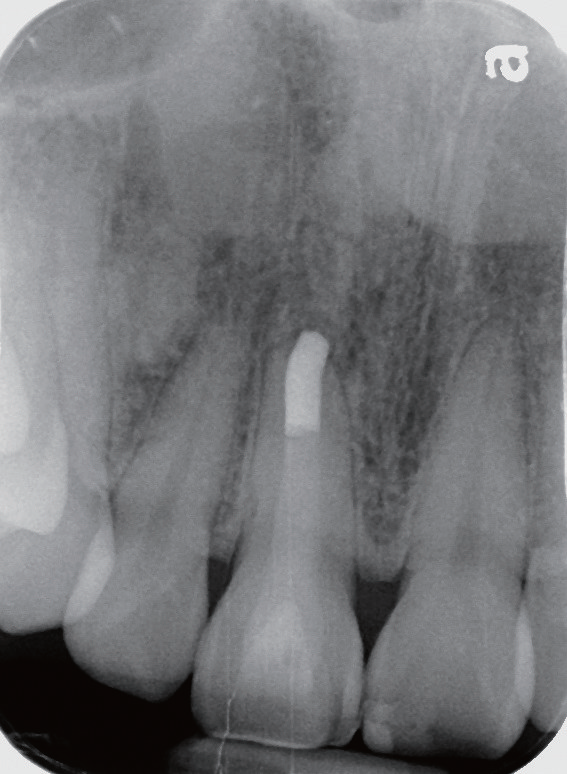 牙胶尖什么颜色MTA的临床应用——陈志平教授_https://www.jmylbn.com_新闻资讯_第18张