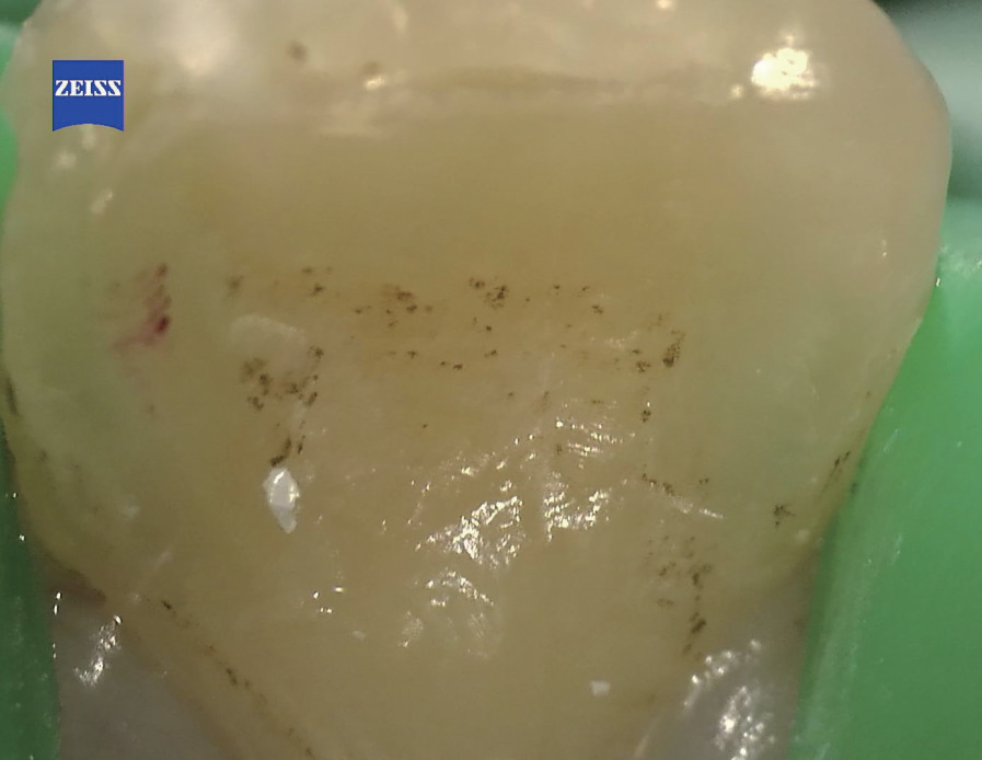 牙胶尖什么颜色MTA的临床应用——陈志平教授_https://www.jmylbn.com_新闻资讯_第5张