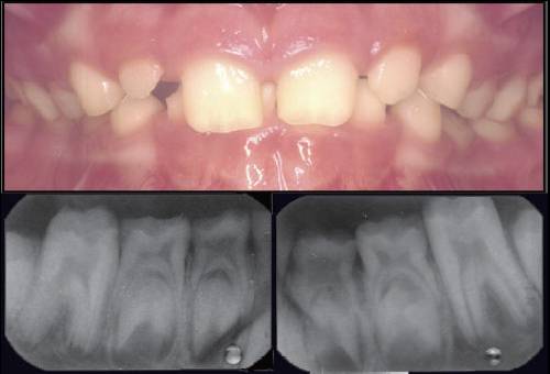 釉质发育不全的诊断与牙体发育异常的治疗——宋亚玲教授