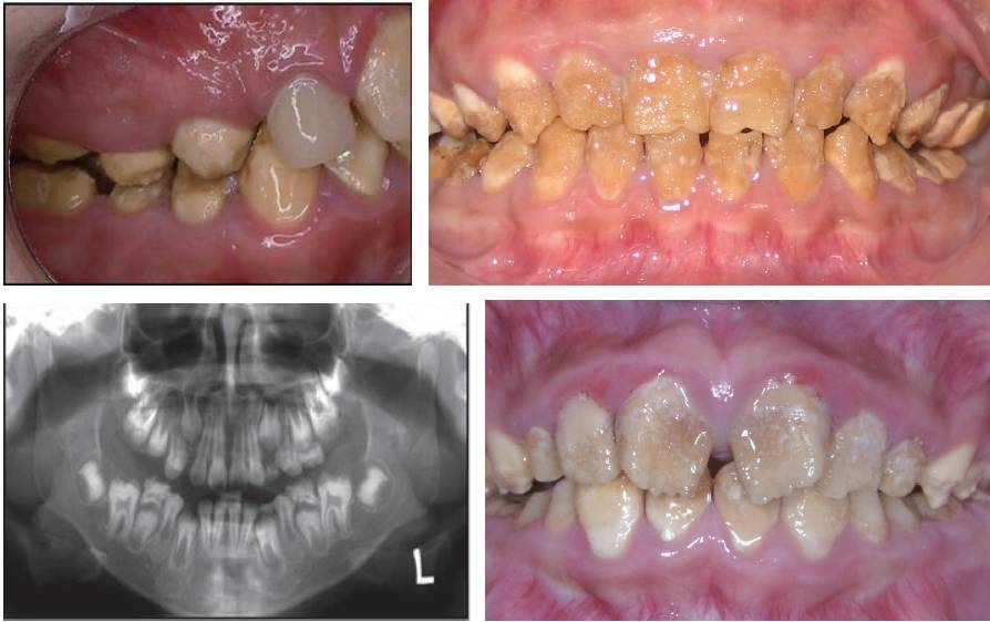 遗传性牙本质发育不全图片