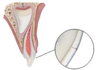 牙齿剧烈疼痛，可能是隐裂惹的祸！
