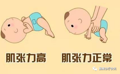 怎么评估病人肌力【视频科普】如何正确评估脑瘫患者的肌张力？与肌力有什么区别？—脑瘫专家常崇旺_https://www.jmylbn.com_新闻资讯_第5张