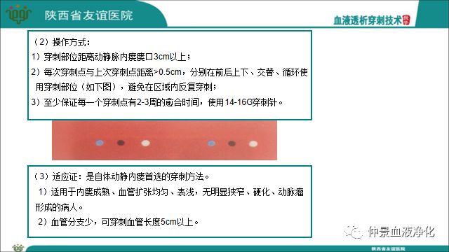 血液透析穿刺技术教学 仲景血液净化 微信公众号文章阅读 Wemp