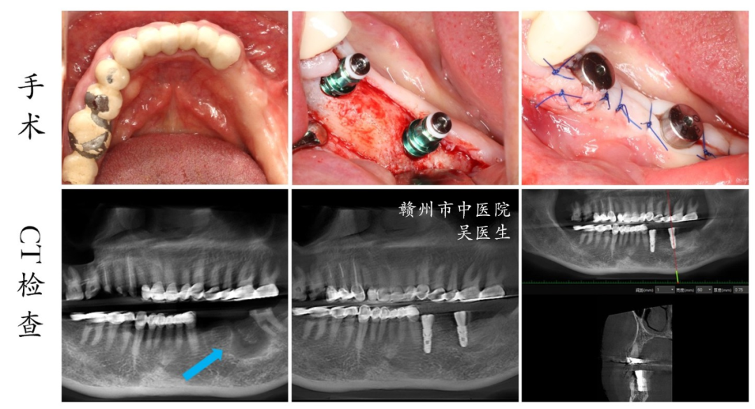 口腔ct怎么拍摄口腔CT —揭秘口腔健康的“透视镜”_https://www.jmylbn.com_新闻资讯_第7张
