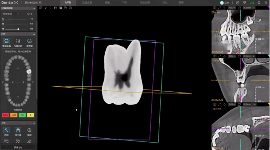 口腔ct怎么拍摄口腔CT —揭秘口腔健康的“透视镜”_https://www.jmylbn.com_新闻资讯_第20张