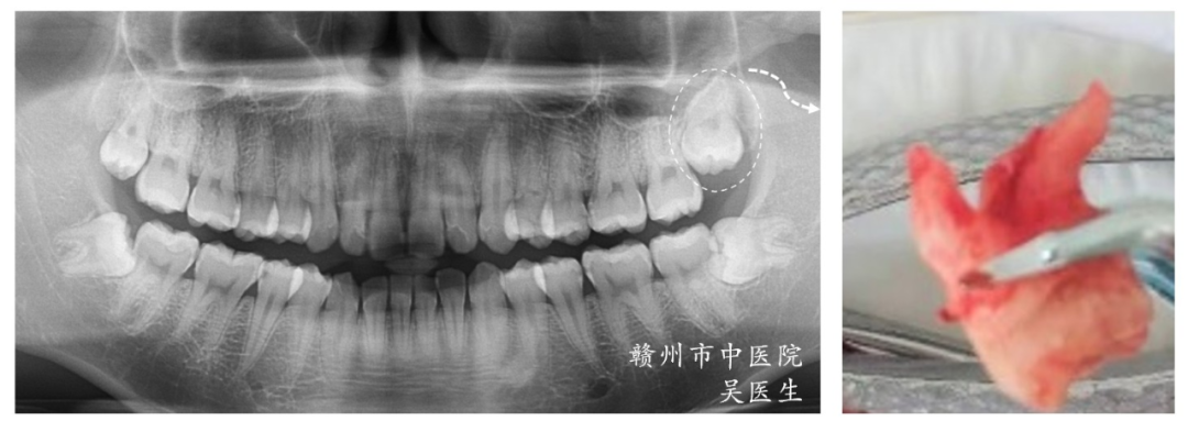 口腔ct怎么拍摄口腔CT —揭秘口腔健康的“透视镜”_https://www.jmylbn.com_新闻资讯_第13张