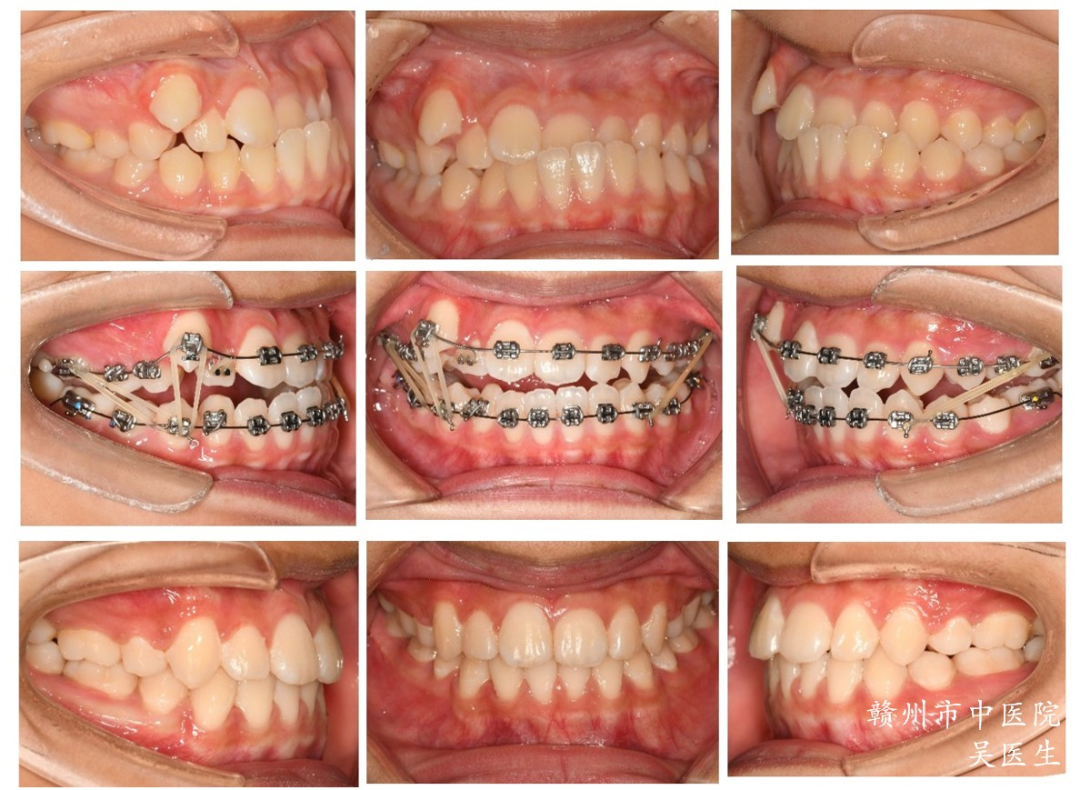 口腔ct怎么拍摄口腔CT —揭秘口腔健康的“透视镜”_https://www.jmylbn.com_新闻资讯_第17张