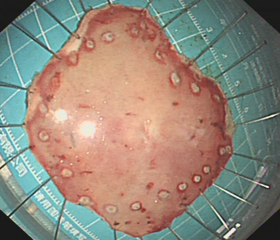 什么是260胃镜医视点 ｜ 精细胃镜使内镜进入“显微时代”_https://www.jmylbn.com_新闻资讯_第9张