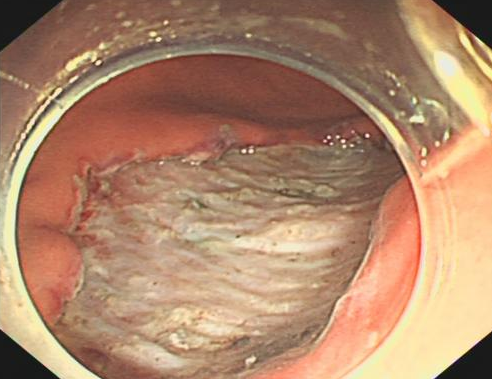 什么是260胃镜医视点 ｜ 精细胃镜使内镜进入“显微时代”_https://www.jmylbn.com_新闻资讯_第8张