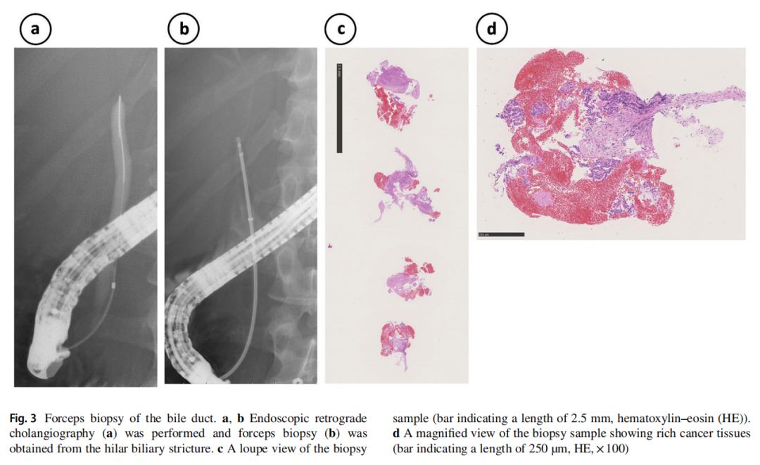 穿刺钳怎么用穿刺or钳夹？胆道癌患者两份样本MSI结果不一致，应用K药取得缓解_https://www.jmylbn.com_新闻资讯_第6张