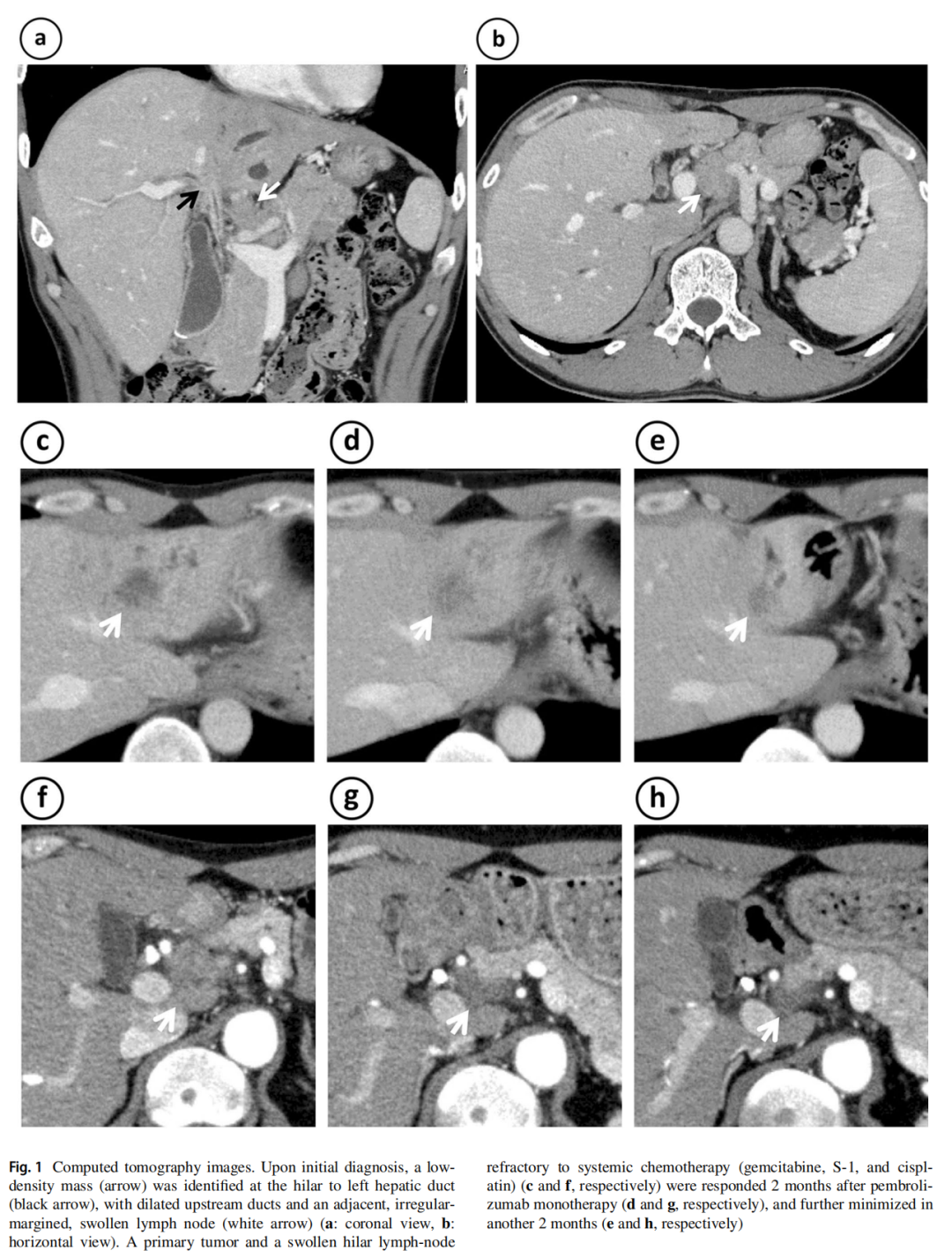 穿刺钳怎么用穿刺or钳夹？胆道癌患者两份样本MSI结果不一致，应用K药取得缓解_https://www.jmylbn.com_新闻资讯_第4张