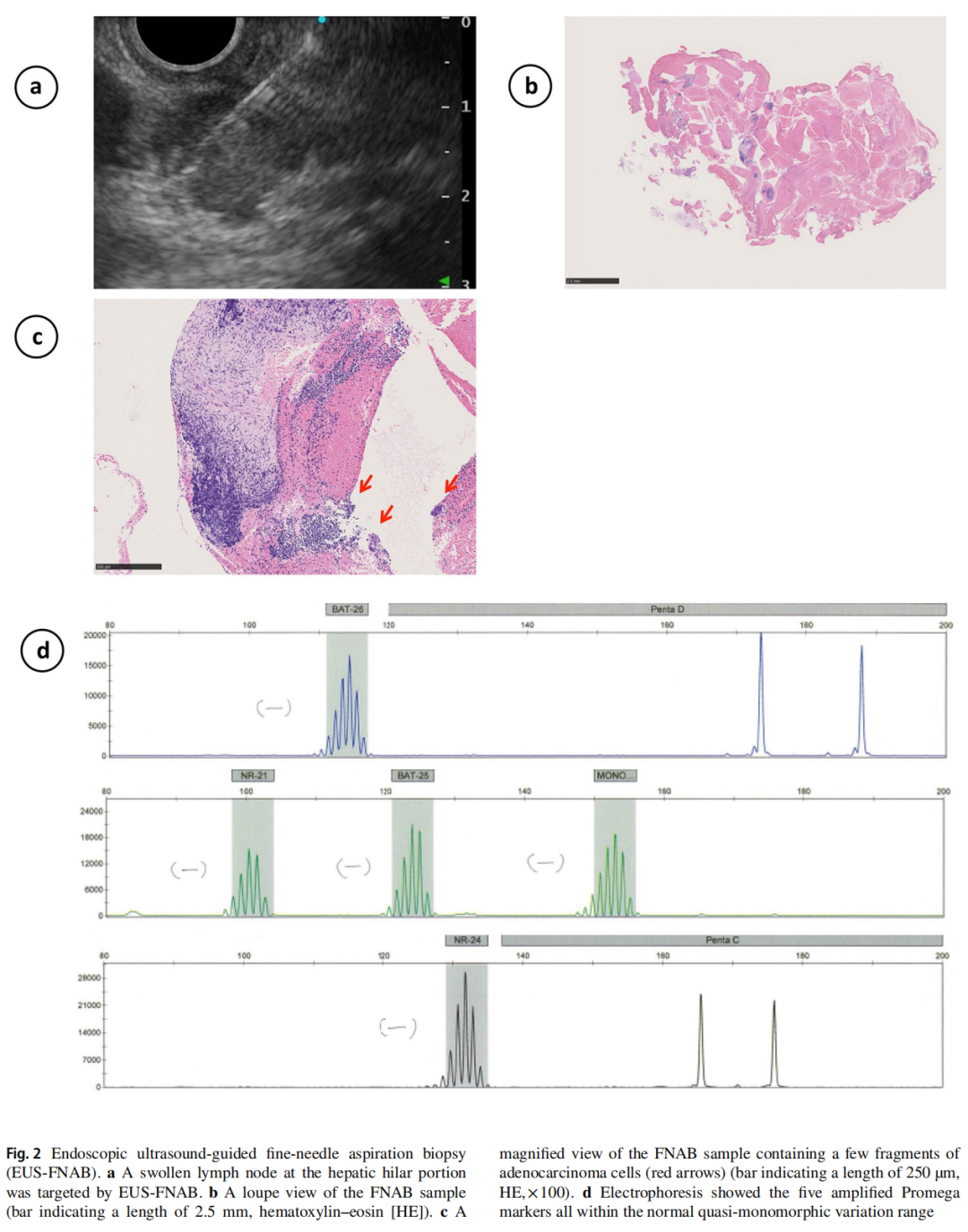 穿刺钳怎么用穿刺or钳夹？胆道癌患者两份样本MSI结果不一致，应用K药取得缓解_https://www.jmylbn.com_新闻资讯_第5张