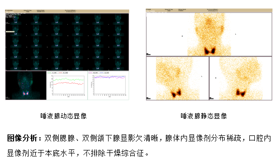 d-spect怎么检查SPECT／CT 检查需要注意什么？看看这里，告诉您这样做~_https://www.jmylbn.com_新闻资讯_第2张