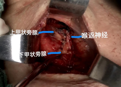 手术切口怎么保护保护你的美丨池州市人民医院甲乳外科应用锁骨上斜切口入路成功开展多例甲状腺肿瘤手术_https://www.jmylbn.com_新闻资讯_第5张