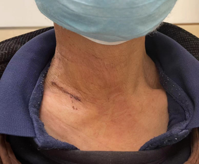 手术切口怎么保护保护你的美丨池州市人民医院甲乳外科应用锁骨上斜切口入路成功开展多例甲状腺肿瘤手术_https://www.jmylbn.com_新闻资讯_第2张