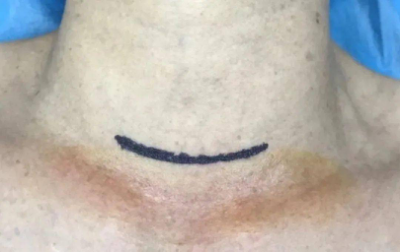 手术切口怎么保护保护你的美丨池州市人民医院甲乳外科应用锁骨上斜切口入路成功开展多例甲状腺肿瘤手术_https://www.jmylbn.com_新闻资讯_第4张