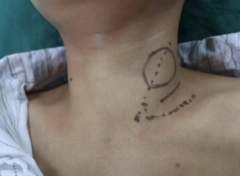 手术切口怎么保护保护你的美丨池州市人民医院甲乳外科应用锁骨上斜切口入路成功开展多例甲状腺肿瘤手术_https://www.jmylbn.com_新闻资讯_第3张