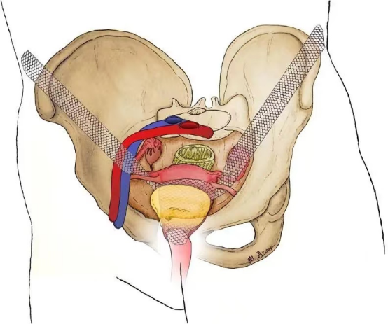 腹腔镜都有什么品牌【品牌技术】腹腔镜下侧腹壁悬吊术让女性患者的“难言之隐”不再隐忍_https://www.jmylbn.com_新闻资讯_第9张