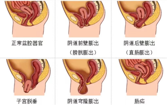 腹腔镜都有什么品牌【品牌技术】腹腔镜下侧腹壁悬吊术让女性患者的“难言之隐”不再隐忍_https://www.jmylbn.com_新闻资讯_第4张