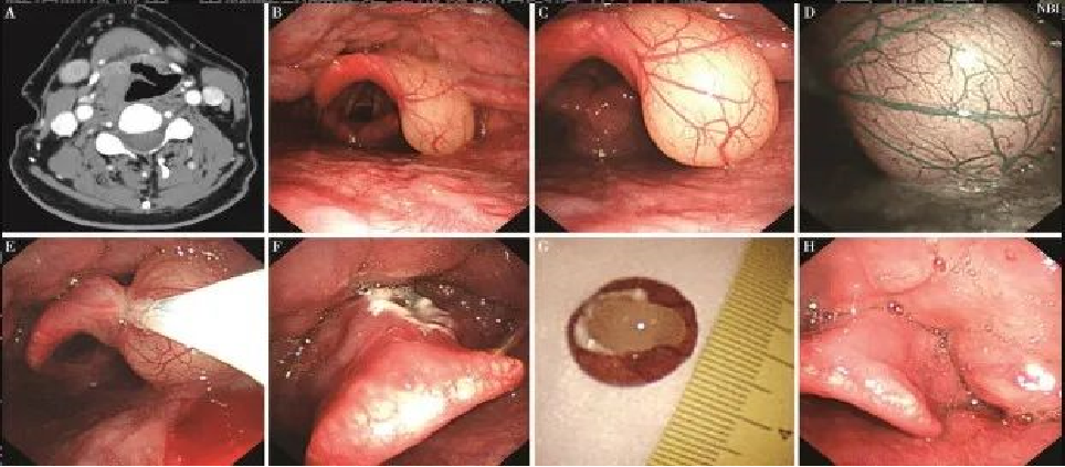 为什么喉镜后做活检电子鼻咽喉镜，让鼻、咽、喉部疾病无处可藏——2021橙乡微创论坛精彩速递（五）_https://www.jmylbn.com_新闻资讯_第10张