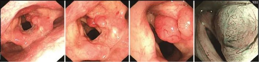 为什么喉镜后做活检电子鼻咽喉镜，让鼻、咽、喉部疾病无处可藏——2021橙乡微创论坛精彩速递（五）_https://www.jmylbn.com_新闻资讯_第19张