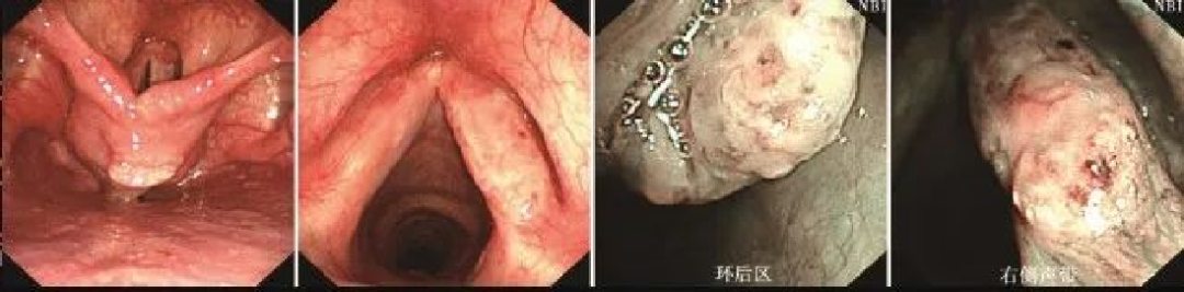 为什么喉镜后做活检电子鼻咽喉镜，让鼻、咽、喉部疾病无处可藏——2021橙乡微创论坛精彩速递（五）_https://www.jmylbn.com_新闻资讯_第14张