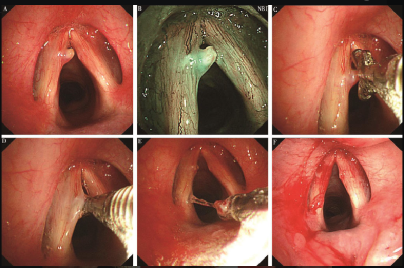 为什么喉镜后做活检电子鼻咽喉镜，让鼻、咽、喉部疾病无处可藏——2021橙乡微创论坛精彩速递（五）_https://www.jmylbn.com_新闻资讯_第7张