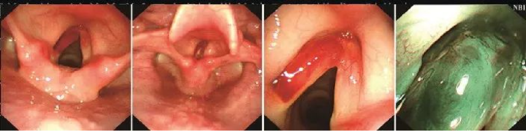 为什么喉镜后做活检电子鼻咽喉镜，让鼻、咽、喉部疾病无处可藏——2021橙乡微创论坛精彩速递（五）_https://www.jmylbn.com_新闻资讯_第9张