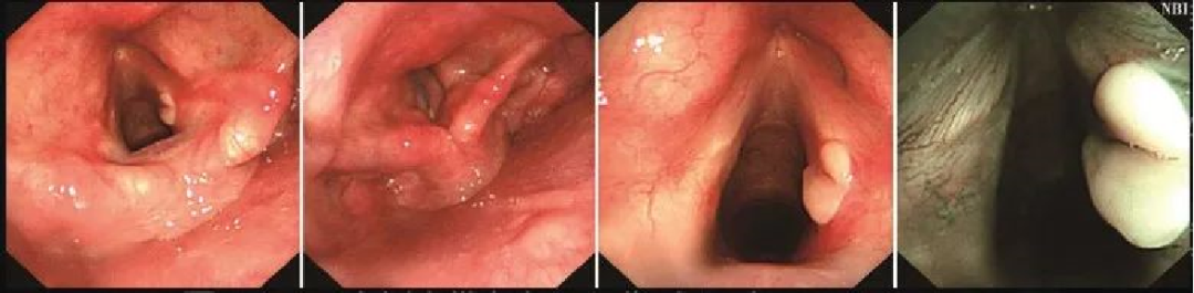 为什么喉镜后做活检电子鼻咽喉镜，让鼻、咽、喉部疾病无处可藏——2021橙乡微创论坛精彩速递（五）_https://www.jmylbn.com_新闻资讯_第8张