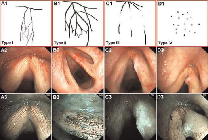 为什么喉镜后做活检电子鼻咽喉镜，让鼻、咽、喉部疾病无处可藏——2021橙乡微创论坛精彩速递（五）_https://www.jmylbn.com_新闻资讯_第5张