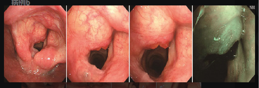 为什么喉镜后做活检电子鼻咽喉镜，让鼻、咽、喉部疾病无处可藏——2021橙乡微创论坛精彩速递（五）_https://www.jmylbn.com_新闻资讯_第13张