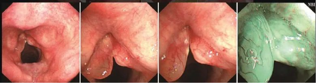 为什么喉镜后做活检电子鼻咽喉镜，让鼻、咽、喉部疾病无处可藏——2021橙乡微创论坛精彩速递（五）_https://www.jmylbn.com_新闻资讯_第11张