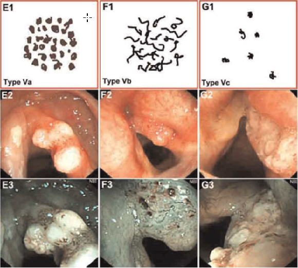 为什么喉镜后做活检电子鼻咽喉镜，让鼻、咽、喉部疾病无处可藏——2021橙乡微创论坛精彩速递（五）_https://www.jmylbn.com_新闻资讯_第6张