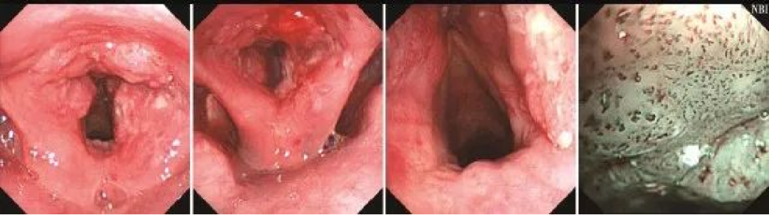 为什么喉镜后做活检电子鼻咽喉镜，让鼻、咽、喉部疾病无处可藏——2021橙乡微创论坛精彩速递（五）_https://www.jmylbn.com_新闻资讯_第16张