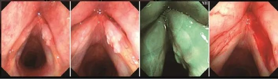 为什么喉镜后做活检电子鼻咽喉镜，让鼻、咽、喉部疾病无处可藏——2021橙乡微创论坛精彩速递（五）_https://www.jmylbn.com_新闻资讯_第12张