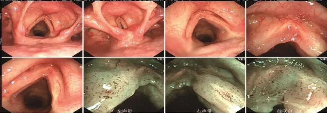 为什么喉镜后做活检电子鼻咽喉镜，让鼻、咽、喉部疾病无处可藏——2021橙乡微创论坛精彩速递（五）_https://www.jmylbn.com_新闻资讯_第15张