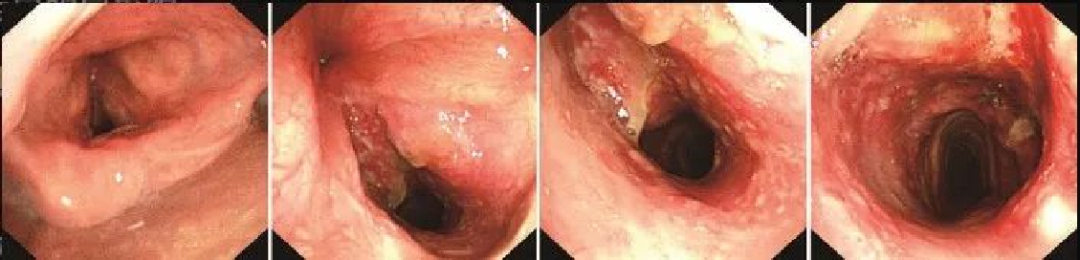为什么喉镜后做活检电子鼻咽喉镜，让鼻、咽、喉部疾病无处可藏——2021橙乡微创论坛精彩速递（五）_https://www.jmylbn.com_新闻资讯_第18张