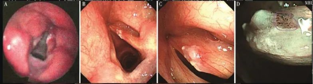 为什么喉镜后做活检电子鼻咽喉镜，让鼻、咽、喉部疾病无处可藏——2021橙乡微创论坛精彩速递（五）_https://www.jmylbn.com_新闻资讯_第17张