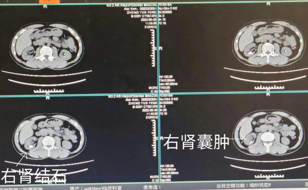 输尿管软镜有什么品牌与石俱净，不用开刀！二附院开展柔性可弯输尿管导引鞘＋电子软镜技术治疗肾结石_https://www.jmylbn.com_新闻资讯_第1张