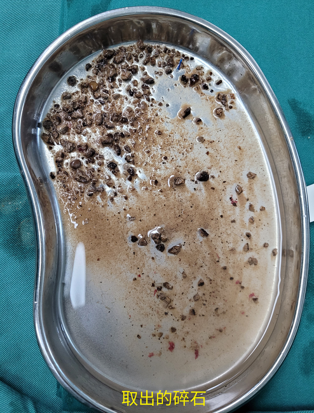 输尿管软镜有什么品牌与石俱净，不用开刀！二附院开展柔性可弯输尿管导引鞘＋电子软镜技术治疗肾结石_https://www.jmylbn.com_新闻资讯_第3张